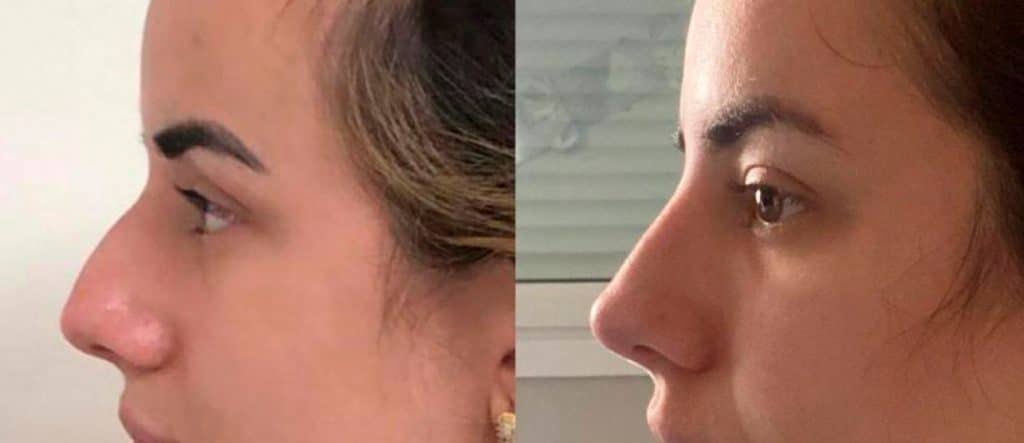 Técnica para mudar o nariz sem cirurgia plástica (Foto: Reprodução/ Internet)