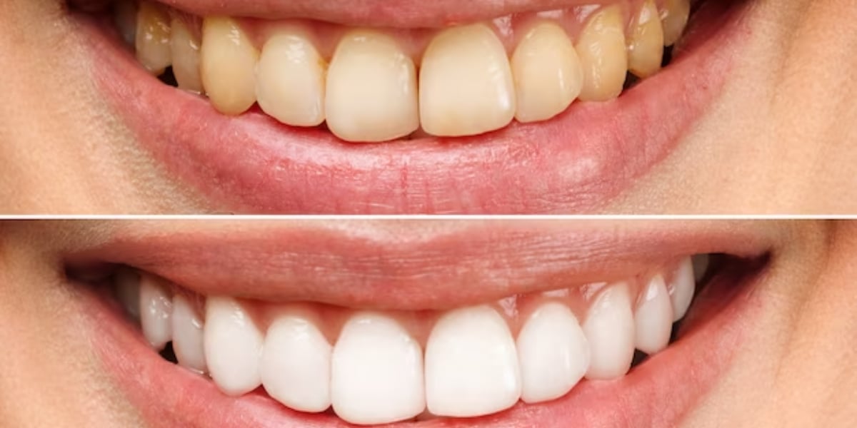 Dentes Brancos e sorriso perfeito com essa receita (Foto: Divulgação)