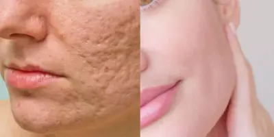 Poros fechados para sempre: 4 dicas INFALÍVEIS dão fim ao pesadelo das mulheres dentro de casa e sem gastar