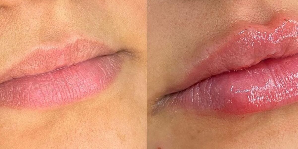 Preenchimento labial totalmente caseiro (Foto: Reprodução/ Internet)