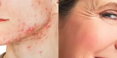 Fim das espinhas e dos pés de galinha: 7 receitas milagrosas para ter um rosto de porcelana e rejuvenescido