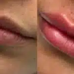 Preenchimento labial (Foto: Reprodução/ portal Antes e Depois)