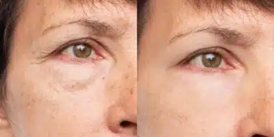 Rugas antes e depois com skincare caseiro (Foto: Divulgação)