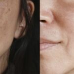 Manchas escuras, antes e depois (Reprodução/Internet)