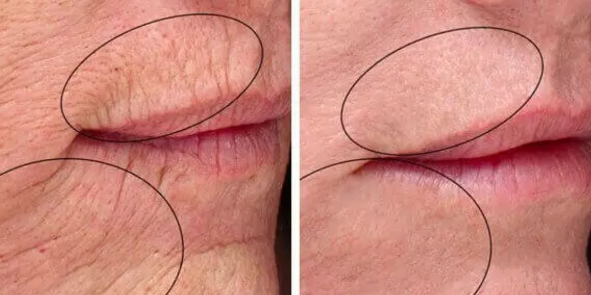 Boca com linhas de expressão e sem (Foto: Reprodução / Portal g97)