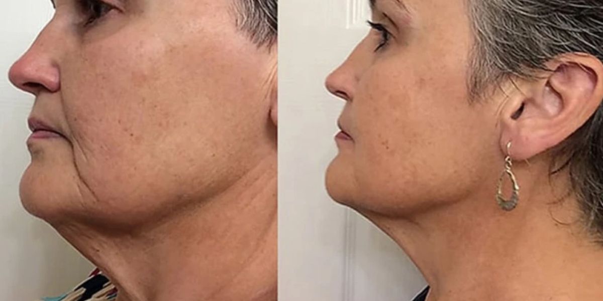 Mulher com e sem rugas (Foto: Reprodução / Portal g97)