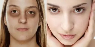 Suga olheiras escuras: Único ingrediente que toda mulher tem em casa acaba com aspecto de cansada em 10 min
