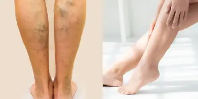 Fim imediato das varizes: 4 truques caseiros eliminam as veias indesejadas nas pernas de mulheres com 60+ em 1h