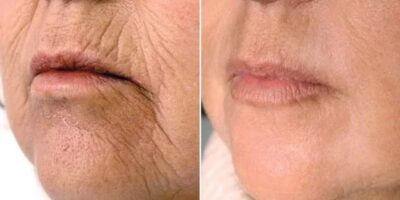 Receitinha com 5 ingredientes rejuvenesce a pele de mulheres 40+ - (Foto: Reprodução / Internet)