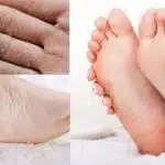 Mãos e pés rachados ao lados de uma pele macia (Foto: Reprodução/ Internet)