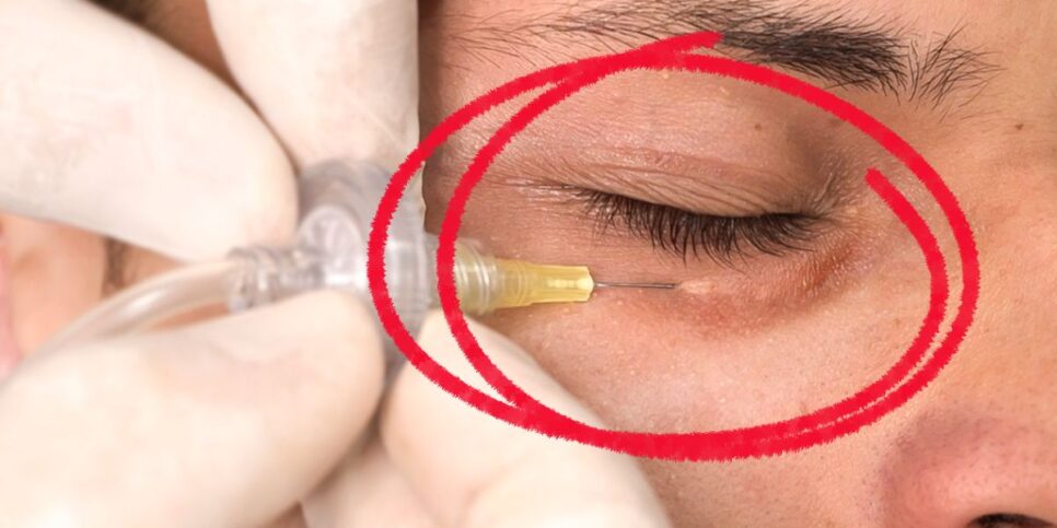 Procedimentos para tratar olheiras, apesar de eficientes podem pesar bastante no bolso (Foto Reprodução/ João Tassinary)