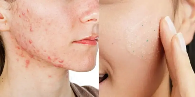 Pele com acne: 5 cuidados para uniformizar o rosto e reduzir as espinhas Pele com acne: 5 cuidados para uniformizar o rosto e reduzir as espinhas