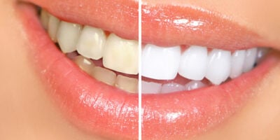 Clareamento te deixa com dentes brancos e sem bafo (Foto: Divulgação)