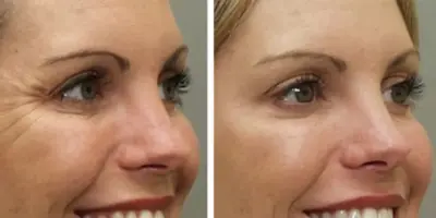 Vão falir as clínicas de estética: Botox caseiro com 5 ingredientes suga às rugas e rejuvenesce 20 anos