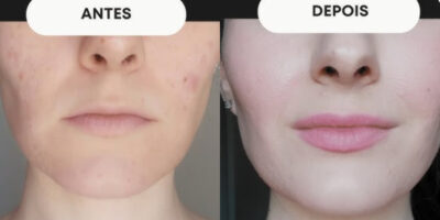 Harmonização facial caseira resultados (Foto: Divulgação)