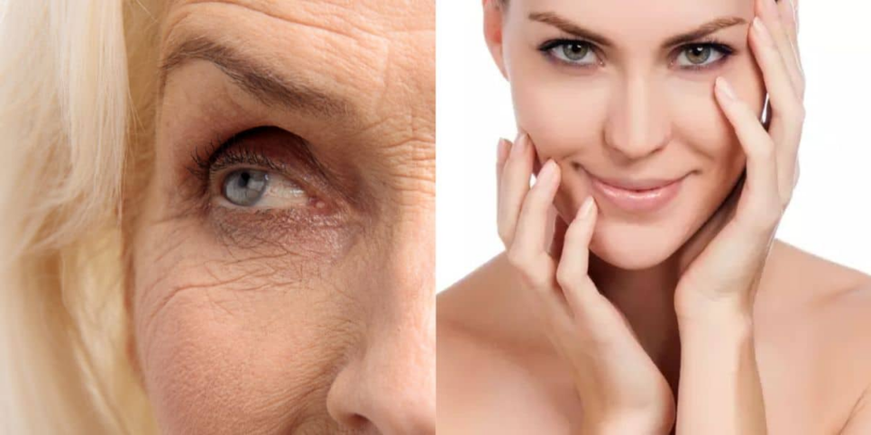 Botox caseiro - foto: TV Foco