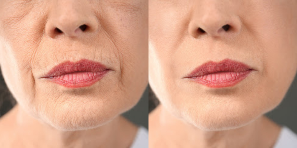 Antes e depois após bioestimulação de colágeno - foto: TV Foco