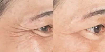 Botox de GRAÇA: Misturinha com 2 ingredientes dá fim as rugas e faz mulheres voltarem aos 30 sem sair de casa