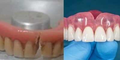 Dentaduras - Montagem: TVFOCO