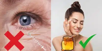 Fim das rugas sem botox e procedimento com Mel (Reprodução - Internet)