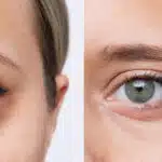 Antes e depois olheiras (Foto: Reprodução - Dr. Iran Sanches)