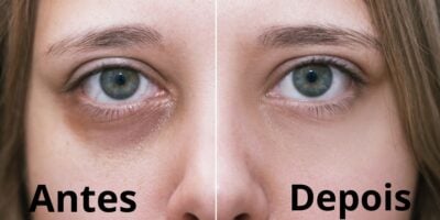 Veja o resultado desse único produto que dá fim as olheiras (Reprodução: Montagem TV Foco)