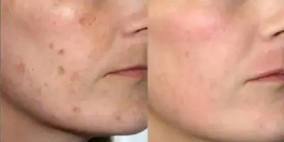 Melhor que ácido hialurônico: Misturinha com 1 fruta acaba com as manchas e deixa a pele brilhando sem oleosidade