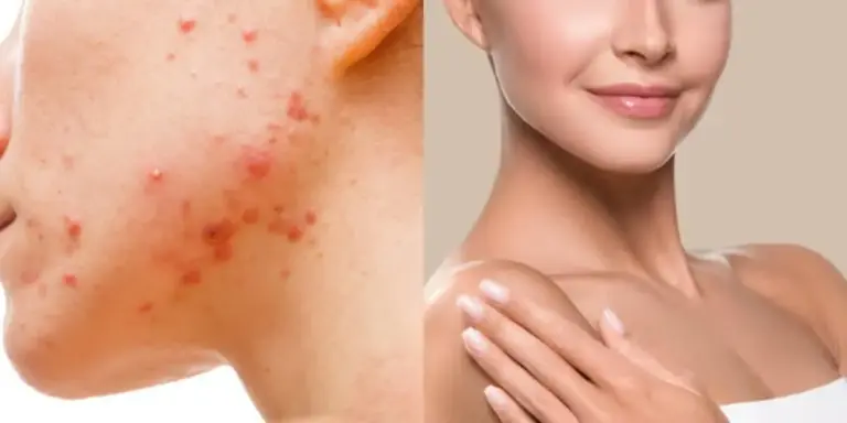 Cravos e espinhas: 4 produtos que ajudam a reduzir marcas na pele