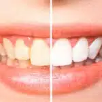 Se livre do tártaro e tenha dentes mais brancos com essa receitinha caseira (Foto/ Reprodução: dentalclean)