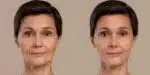 Antes e depois das Rugas (Foto: Reprodução - Clinica Marina Ceruti)