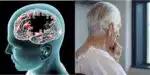 Alzheimer (Foto Reprodução/Montagem/Tv Foco)