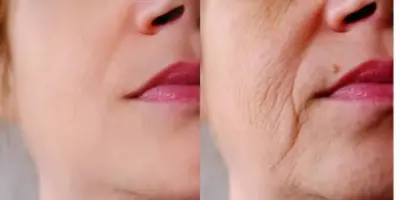 Fim das rugas e das manchas na pele: Único ingrediente traz pele de porcelana em 15 minutos às mulheres 50+