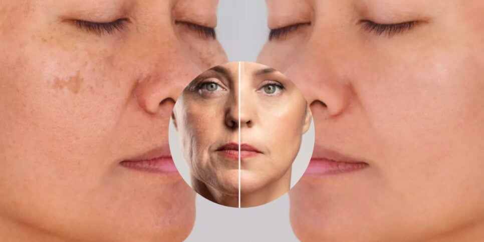 Botox caseiro com 2 ingredientes dá fim as manchas e rugas (Foto: Reprodução/ Internet)