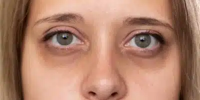 Veja como diminuir as olheiras (Foto: Reprodução / Freepik)