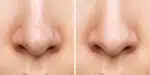 Único ingrediente natural arranca cravos do nariz sem dor (Reprodução/Freepik)