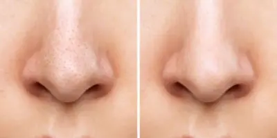 Melhor que limpeza de pele: Único ingrediente natural arranca cravos do nariz sem dor