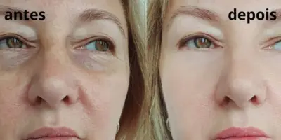 Tchau, rugas: Único ingrediente natural e que você tem em casa, traz pele de bebê às mulheres 50+