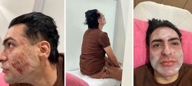 Henrique Chagas ficou com ferimentos no rosto após peeling de fenol (Foto: Reprodução / Marcelo Camargo)