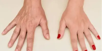 Mão enrugada nunca mais: Colágeno puro com ingrediente caseiro rejuvenesce em segundos