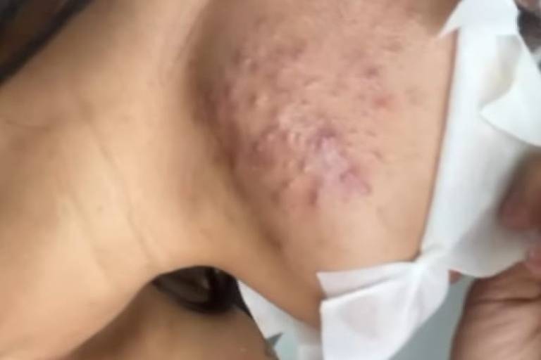 Entre os efeitos colaterais a acne na pele está na lista e de forma bem agressiva (Foto: Reprodução/ Instagram)