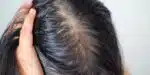 Cabelo oleoso - Oleosidade (Foto: Reprodução - Shutterstock)