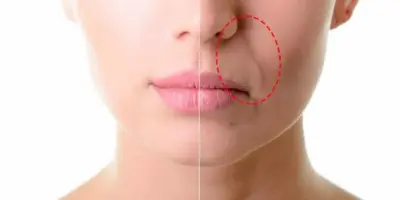 Adeus bigode chinês e rugas: Mistura natural com 4 ingredientes infalíveis te dá pele de porcelana