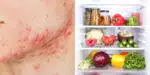 Espinhas podem chegar ao fim com esse alimento da sua geladeira (Foto: Divulgação)