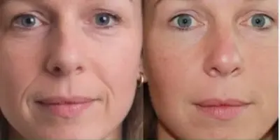 Exilir da juventude e fim das rugas: Creme antirrugas totalmente caseiro rejuvenesce as 60+