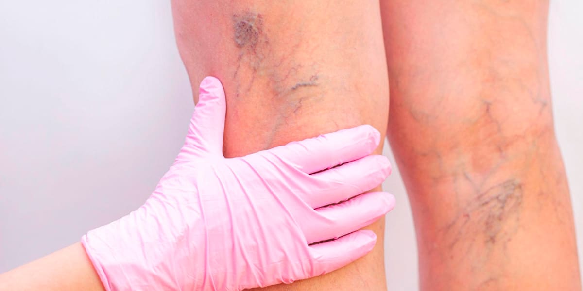 varizes-adeus Adeus varizes com essa receita (Foto: Divulgação)