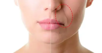 Adeus bigode chinês e rugas: Mistura natural com 4 ingredientes infalíveis te dá pele de porcelana