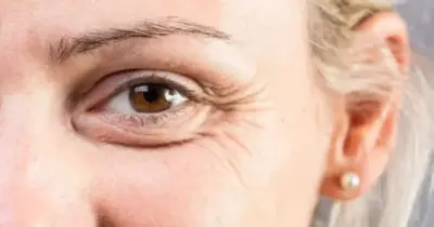 Receita de botox caseiro rejuvenesce mulheres de 50+, traz pele de porcelana e ainda elimina todas as rugas