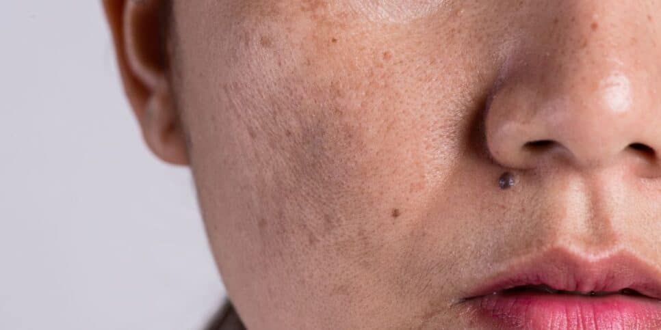 Ilustração melasma (Foto: Canva)