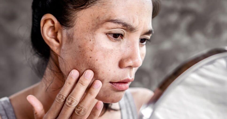 Mulher com melasma (Foto: Canva)