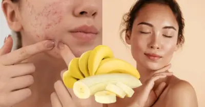 Pele lisinha eternamente: Limpeza facial caseira com banana remove cravos e espinhas sem dor